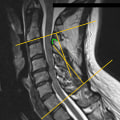 The Importance of Early MRI for Whiplash Injuries