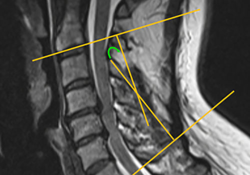 The Importance of Early MRI for Whiplash Injuries